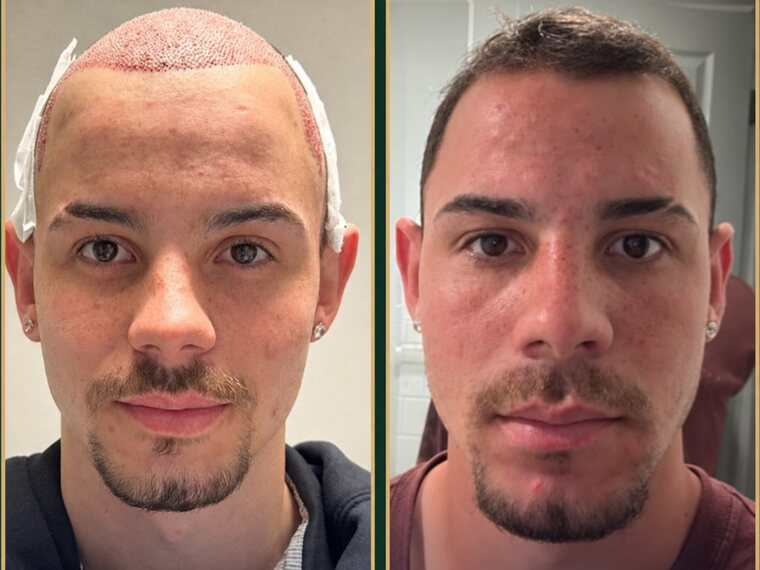 Peak Hair Restoration Sapphire FUE patient before-and-after image