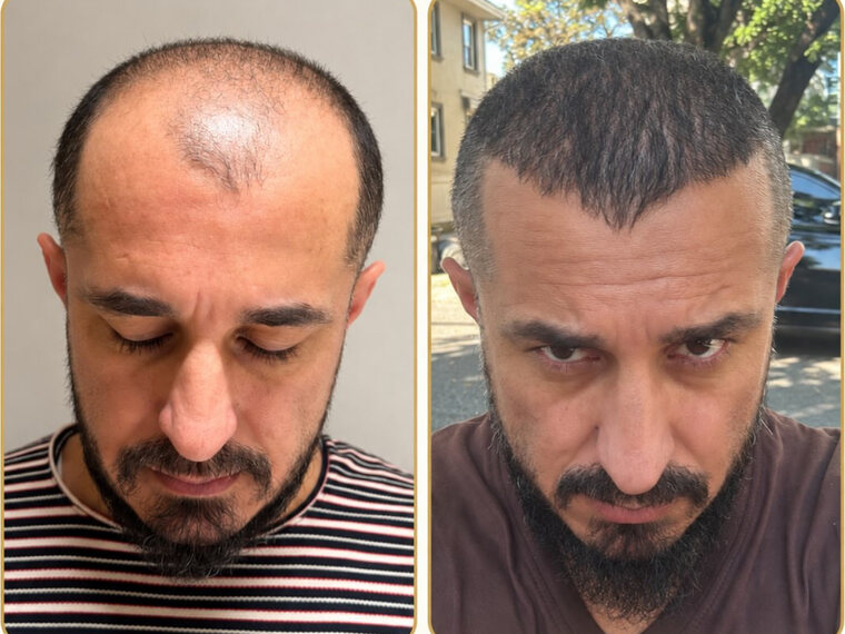 Peak Hair Restoration patient before and after Sapphire FUE