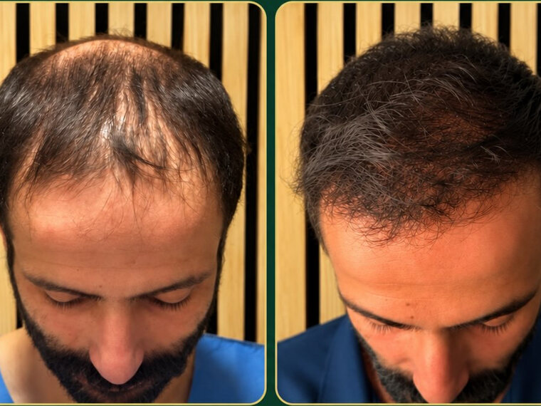 Peak Hair Restoration patient before and after Sapphire FUE