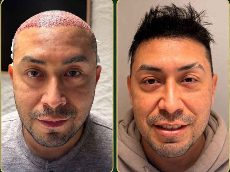 Peak Hair Restoration patient before and after Sapphire FUE