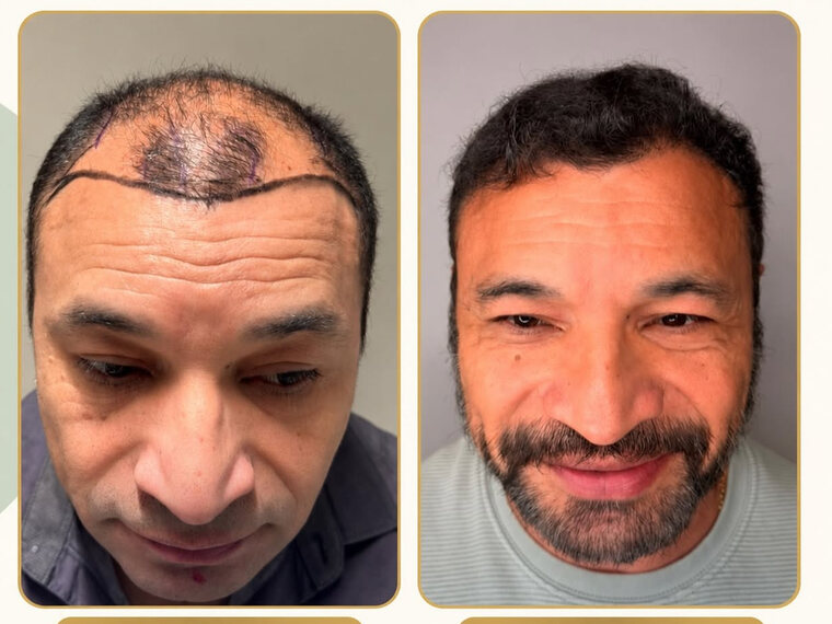 Peak Hair Restoration patient before and after Sapphire FUE
