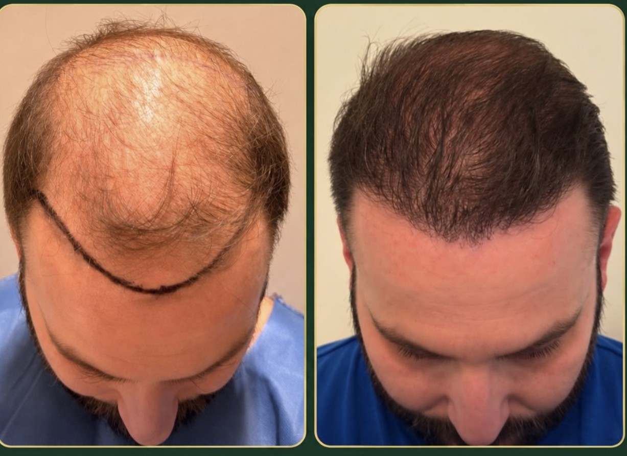 Patient before hair transplant and after five months of progress
